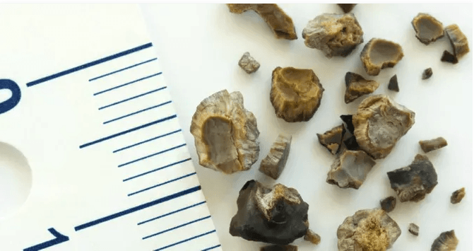 Böbrek Taşı Belirtileri ve Doğal Tedavisi