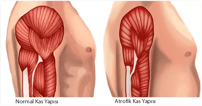 Kas Kaybı (Atrofi) Rehberi