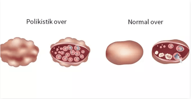Polikistik Over (PCOS) İle Sağlıklı Yaşam Rehberi